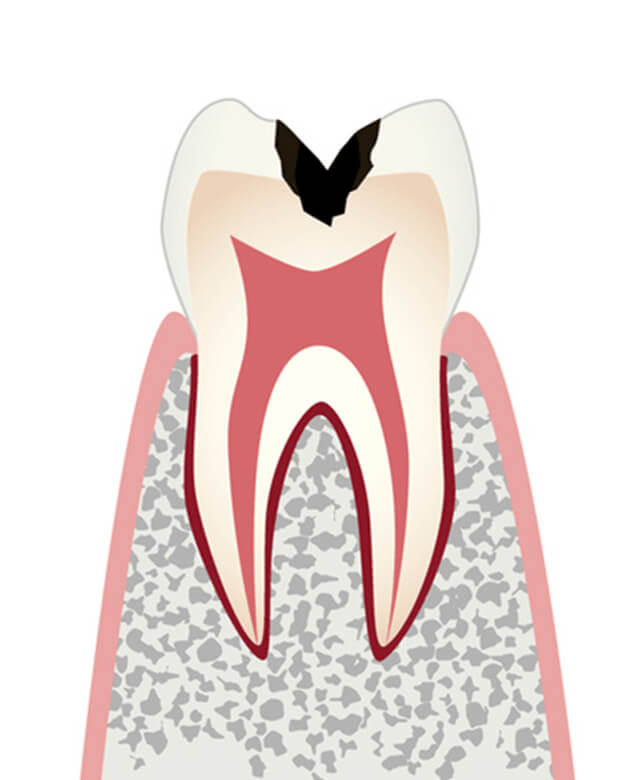C2：歯の内部（象牙質）まで進行したむし歯