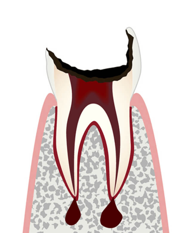 C4：歯根まで進行したむし歯