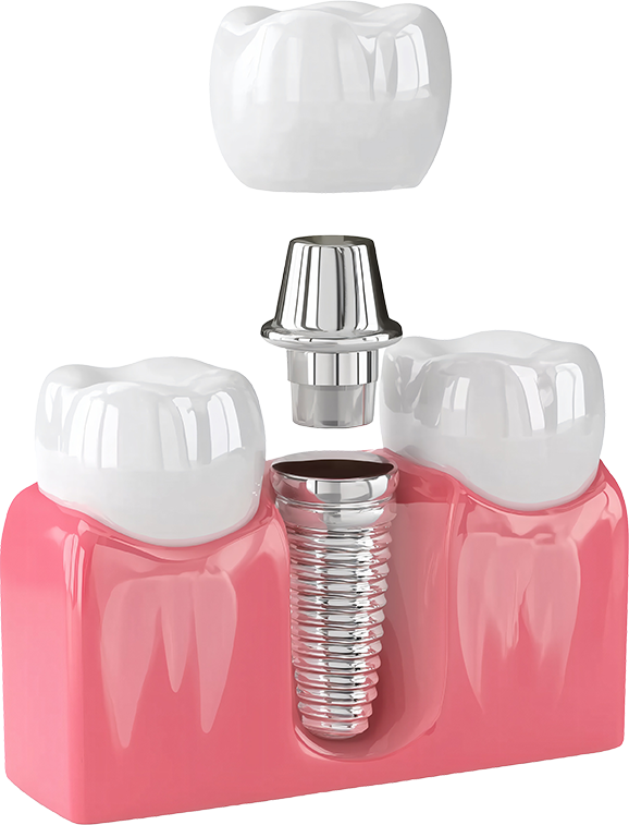 インハウスアライナー